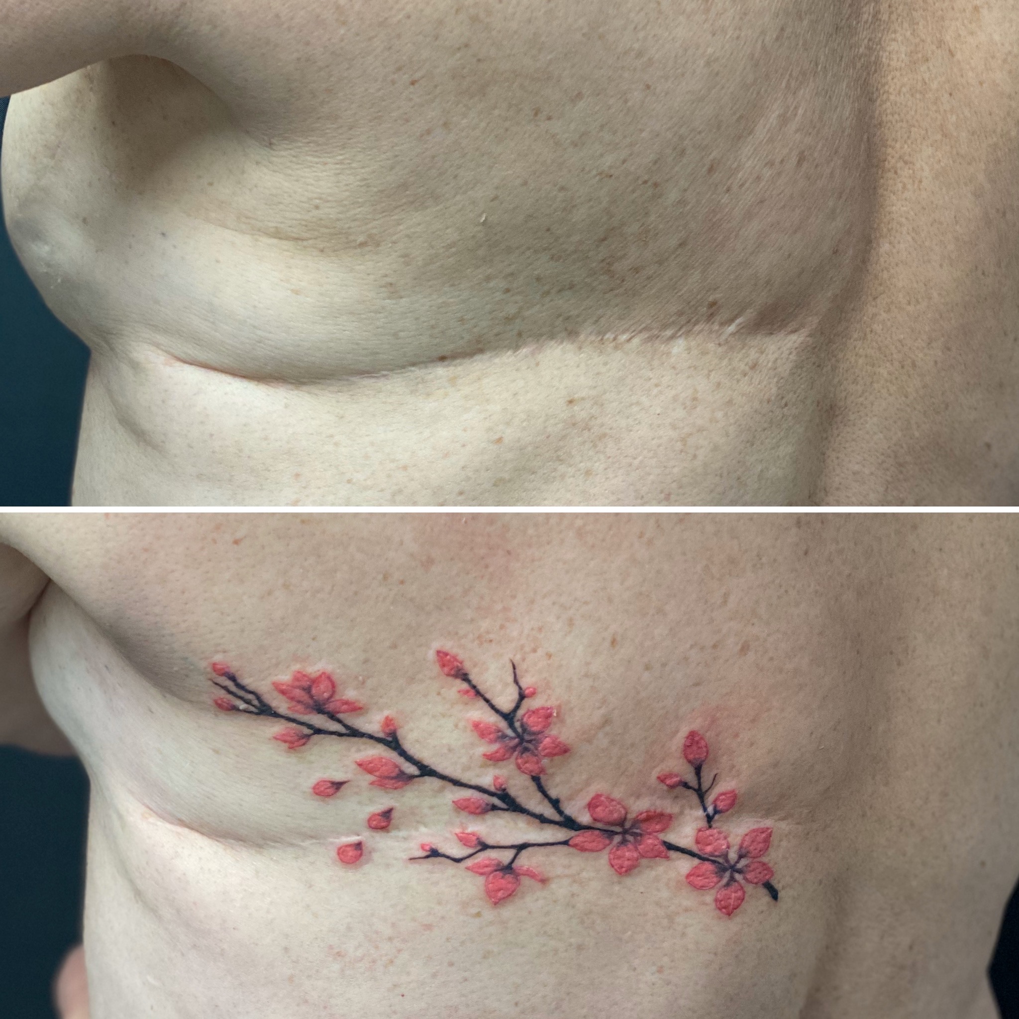 Le tatouage artistique sur cicatrice de mastectomie -